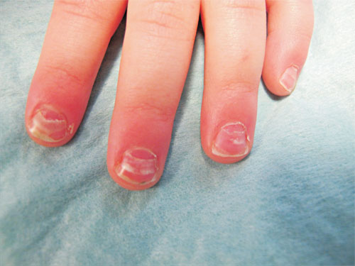 Nail Separation (Onycholysis): Check Your Symptoms and Signs