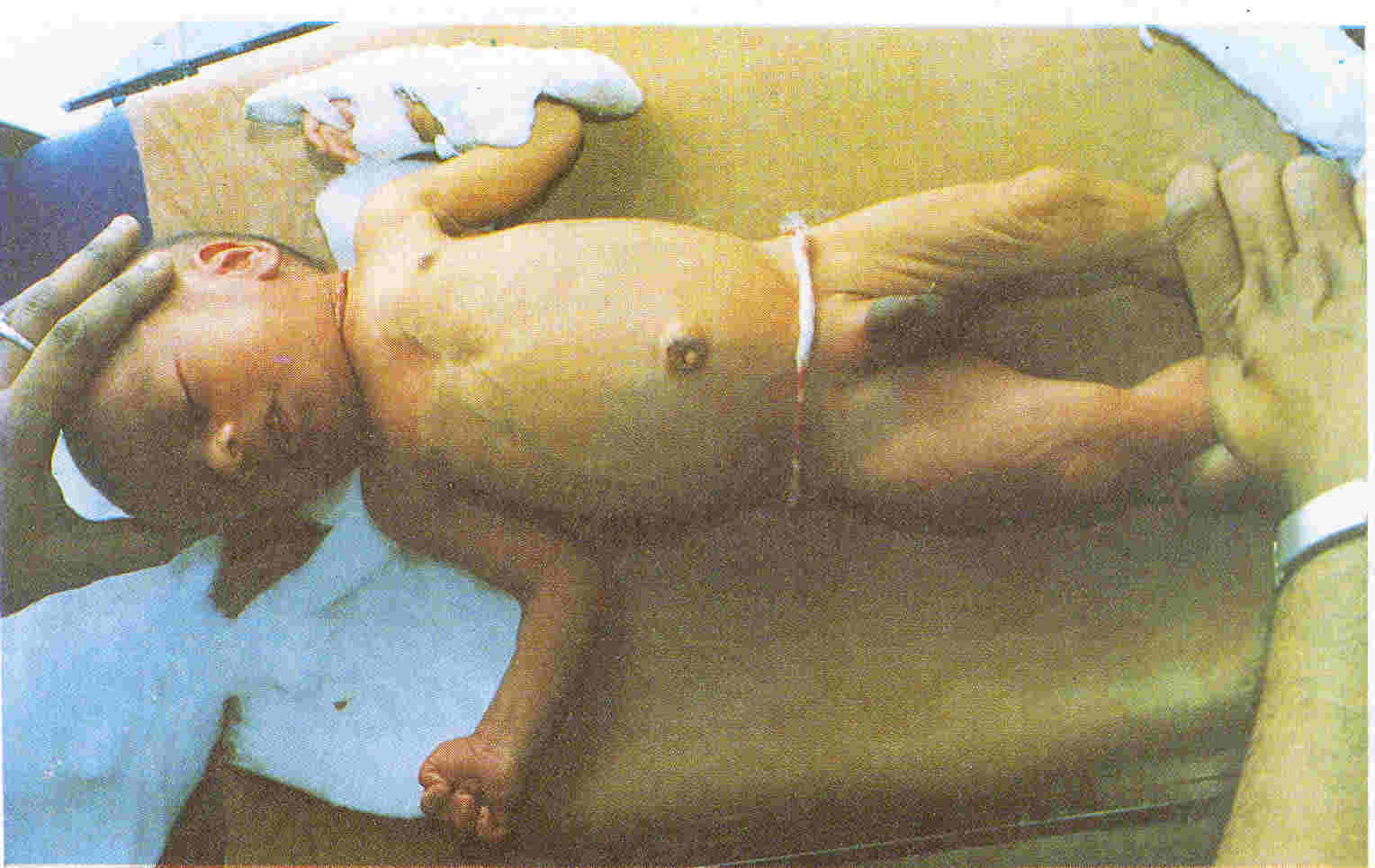 Varicose Abdominal Veins