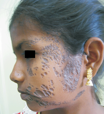 Nevoid basal cell carcinoma syndrome: MedlinePlus Medical ...