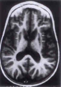 Areas of signal hypointensity in putamen bilaterally as well as in the head of the caudate nucleus on T1-weighted images (Leigh's disease). 