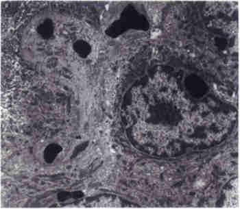Electron microscopy of skin biopsy showing the characteristic electron dense cytoplasmic granules in keratinocyte