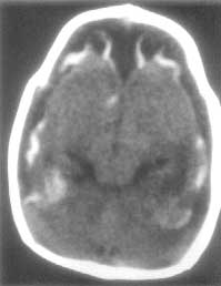 ct cortical scan mantle calcified overlapping severe atrophy thin brain fig showing child head