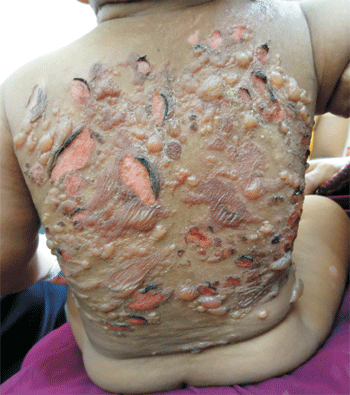 cutaneous mastocytosis