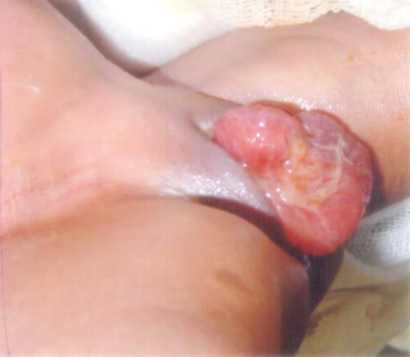 genital abnormalities pictures
