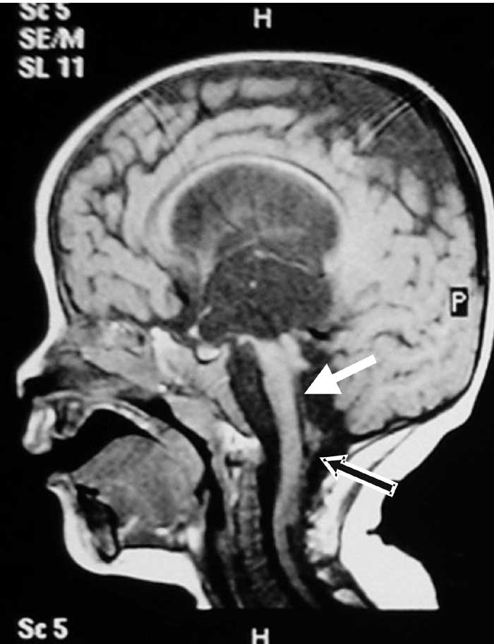 Chiari Malformation Type II with Vanishing Cerebellum