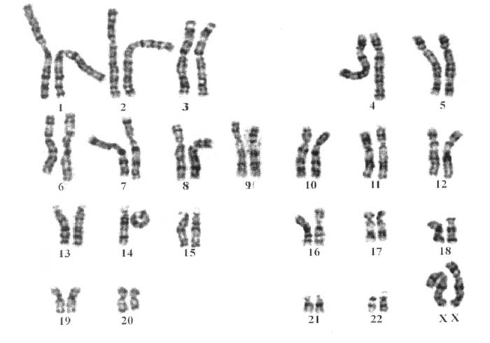 Forty-two supernumerary marker chromosomes (SMCs) in 43 273 prenatal  samples: chromosomal distribution, clinical findings, and UPD studies |  European Journal of Human Genetics