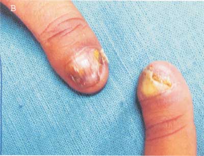 Inherited nail diseases - Dermatologie - Universimed - Medizin im Fokus