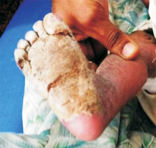 Crusted Scabies