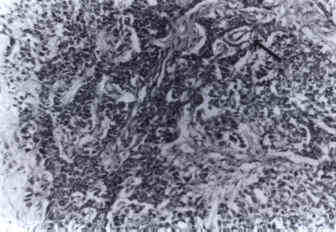 Yolk sac tumor showing trabecular arrangement of cells. Note perivascular formations (Schiller-Duval bodies), arrow (H&E,  160)
