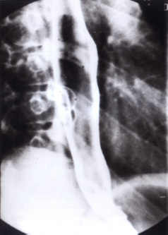  Esophageal lumen and mucosa are normal on the barium swallow done the next day