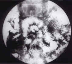 Barium meal follow through reveals a large number of worms in the small intestine