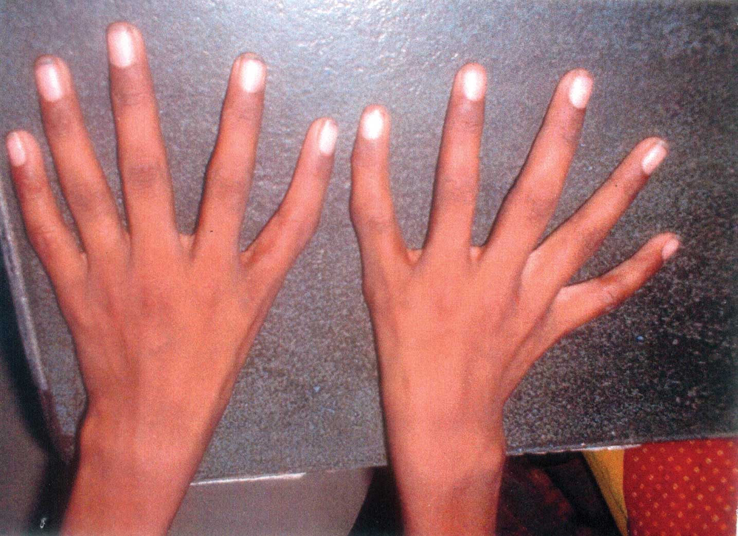Причина толстых рук. Арахнодактилия паучьи пальцы. Арахнодактилия паучьи пальцы тонкие.