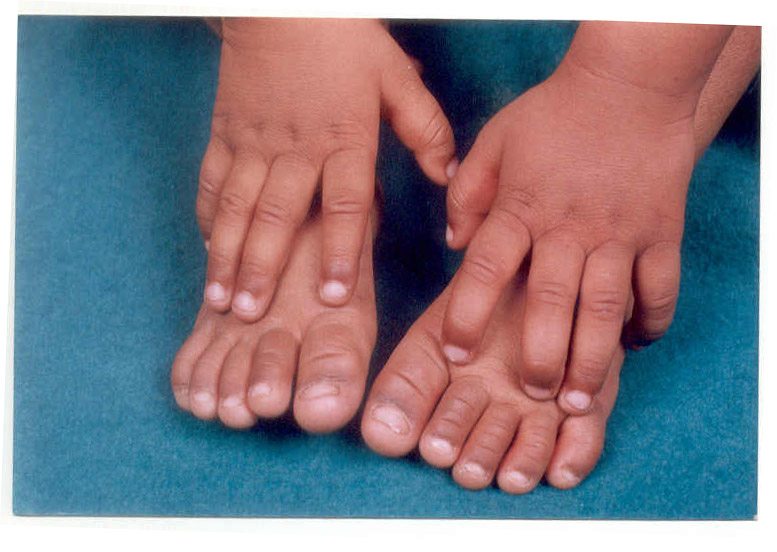 Indian Pediatrics - Editorial Indian Pediatrics - Editorial