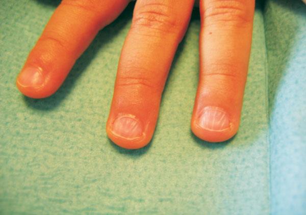 Rheumatoid Arthritis Nail Changes: Causes and Treatments