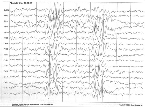 Abnormal eeg normal vs epilepsy - vametbingo