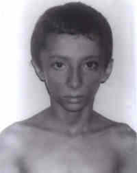 Fig. 2. Facial appearance of patient at 9 years of age showing loss of buccal fat. 
