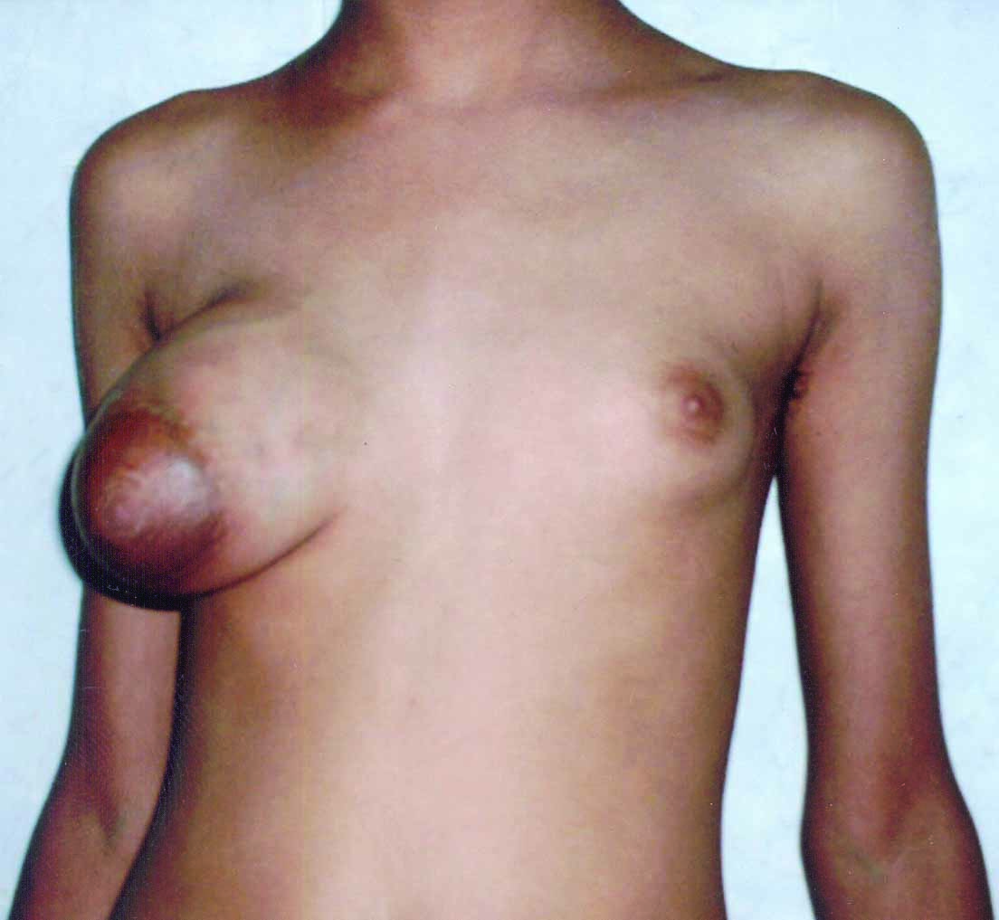 1. Enlarged right breast due to fibroadenoma. 