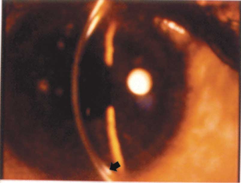 Is anterior segment OCT superior to slit-lamp biomicroscopic examination  for Kayser Flesicher ring in Wilson's disease?