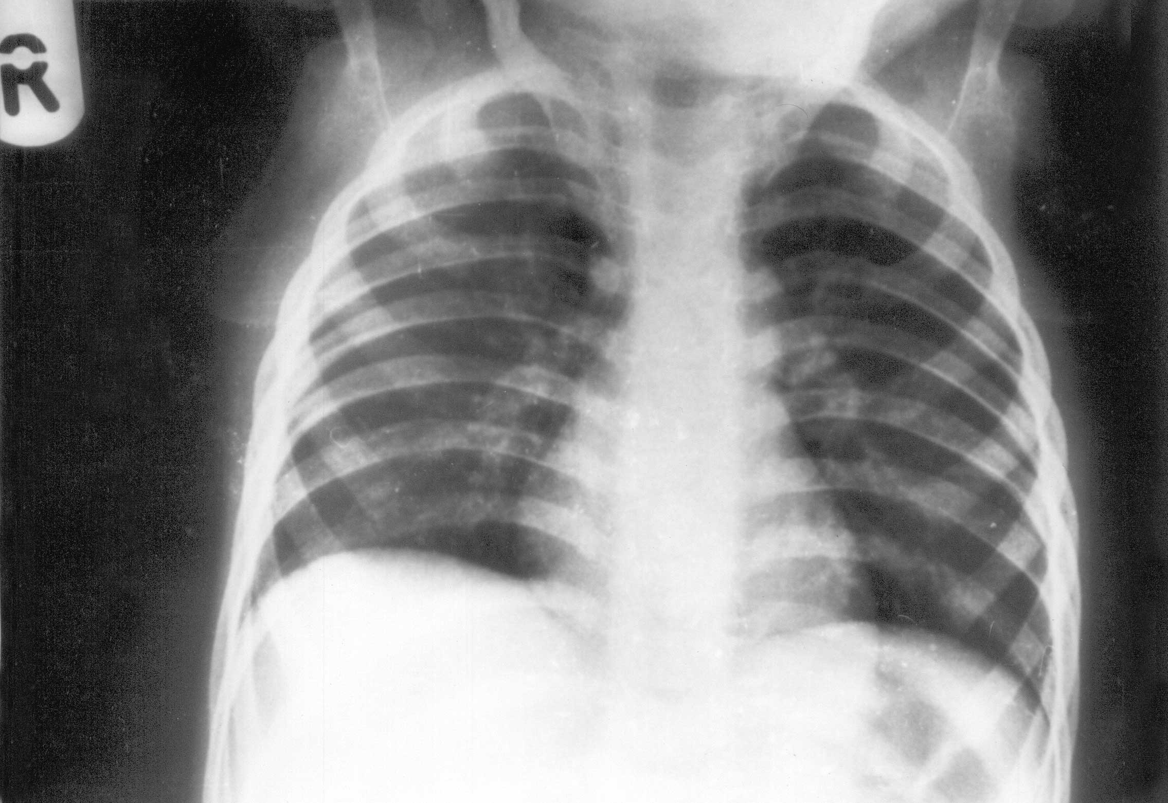 Врожденный туберкулез. Врожденный туберкулез рентген. Туберкулез у детей рентген. Снимок туберкулеза легких. Врожденный туберкулез у детей.