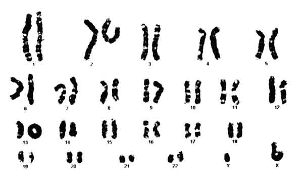 A karyotype of 46,XY,r(21). | Download Scientific Diagram