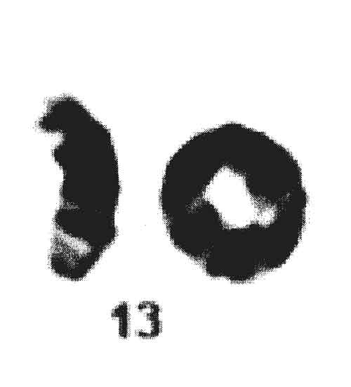 Mosaic ring chromosome 21, monosomy 21, and isodicentric ring chromosome  21: Prenatal diagnosis, molecular cytogenetic characterization, and  association with 2-Mb deletion of 21q21.1–q21.2 and 5-Mb deletion of  21q22.3 - ScienceDirect