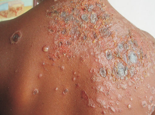 bullous impetigo in children