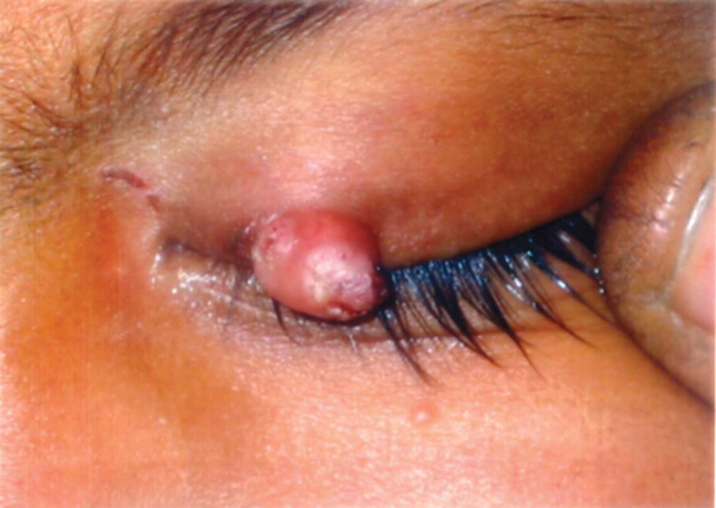 Eyelid wart discount