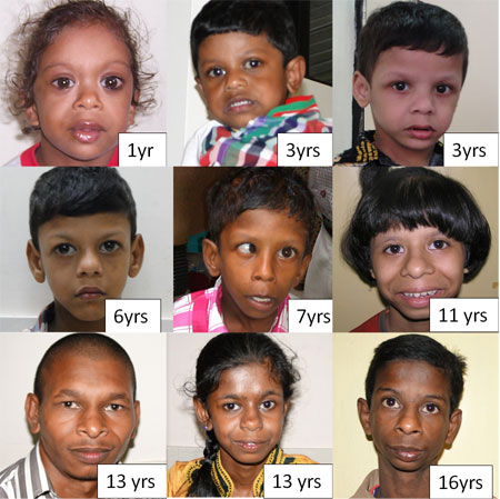 Beste Williams Syndrome: A Case Series TU-54