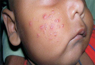 Infantile Acne