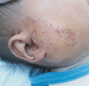 Parotid Gland Hemangioma