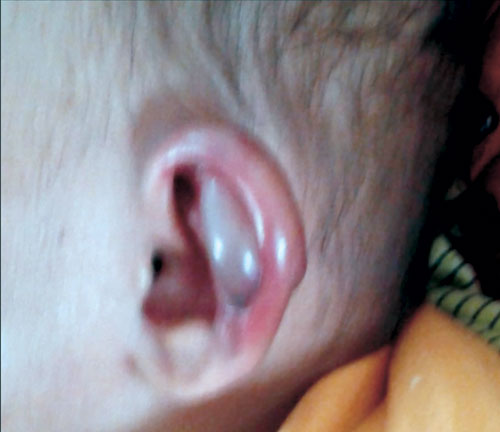 Auricular Blister A Rare Transfusion Reaction